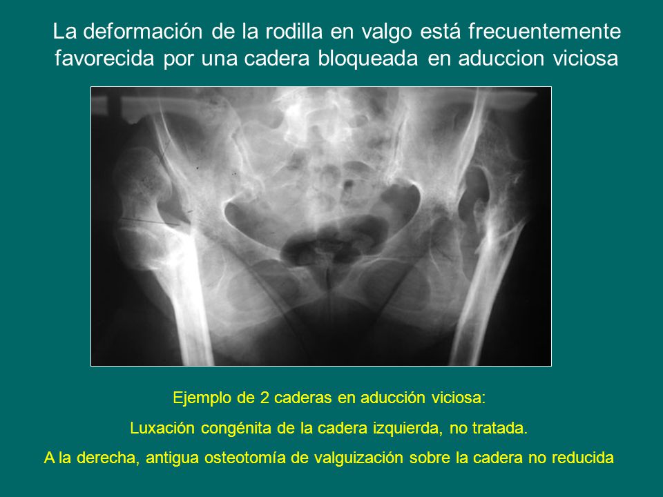 La deformación de la rodilla en valgo está frecuentemente favorecida por una cadera bloqueada en aduccion viciosa