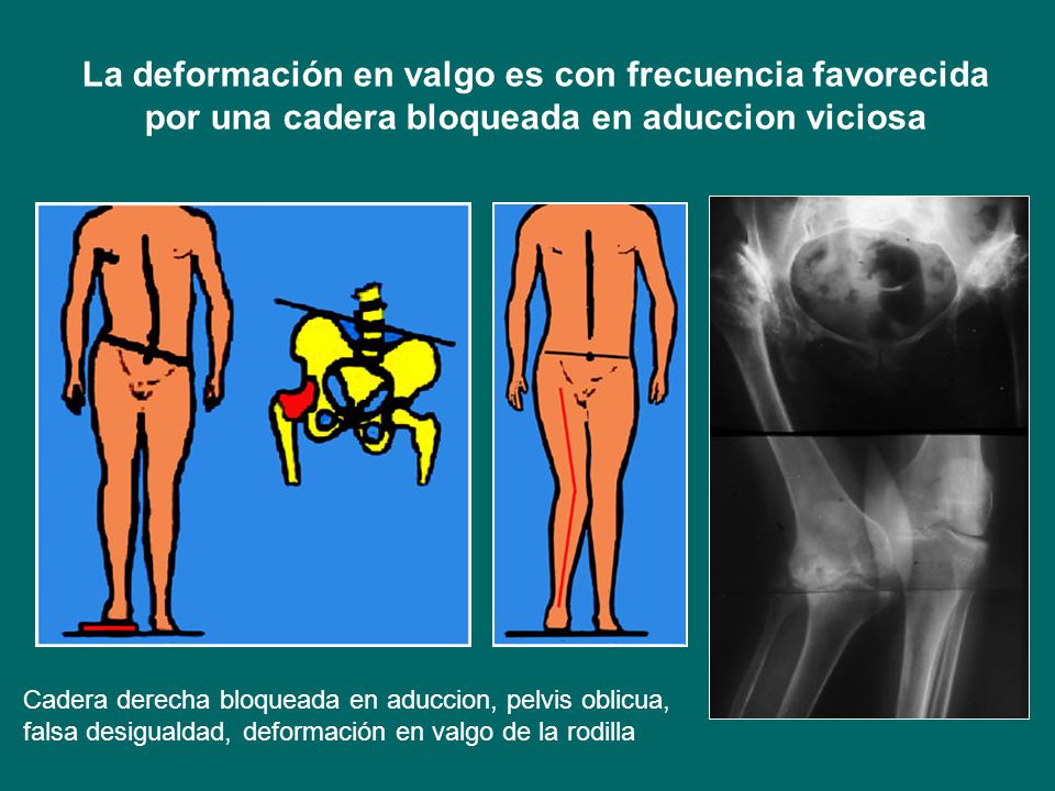 La deformación en valgo es con frecuencia favorecida por una cadera bloqueada en aduccion viciosa