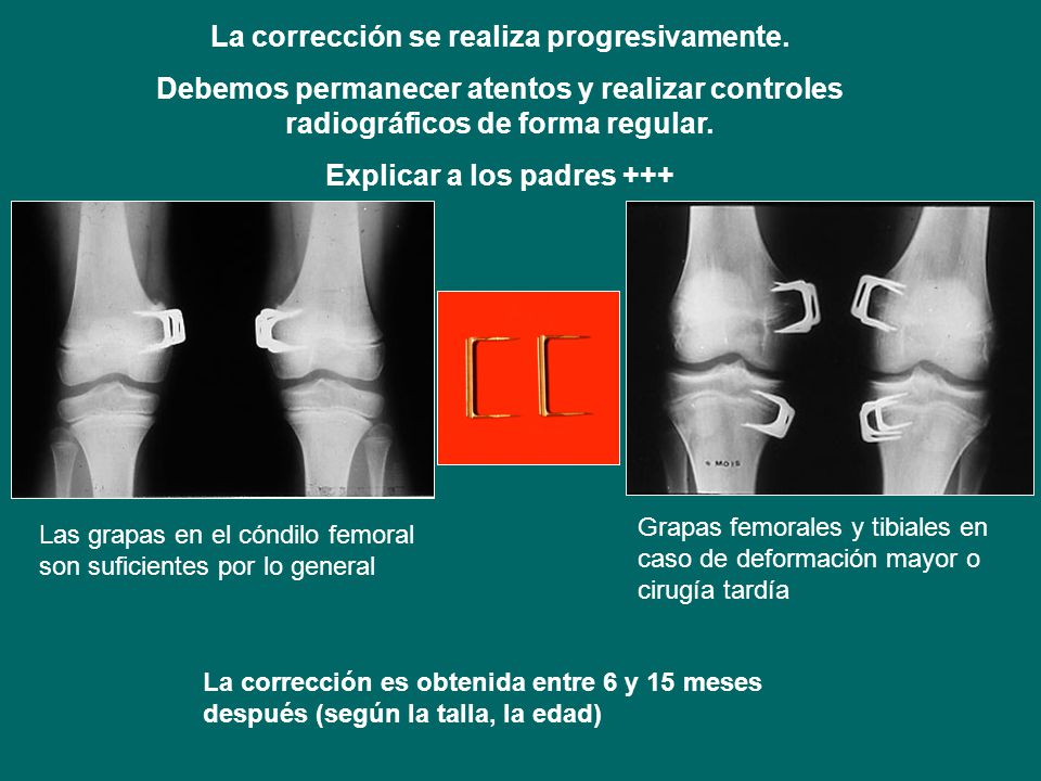 La corrección se realiza progresivamente. Explicar a los padres +++
