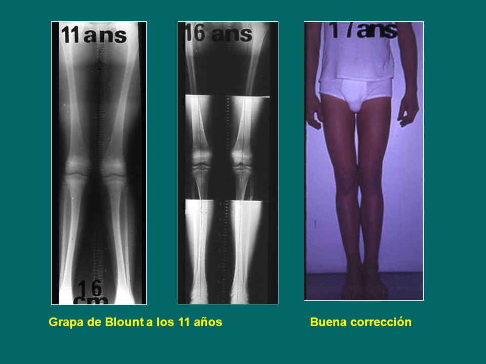 Grapa de Blount a los 11 años Buena corrección