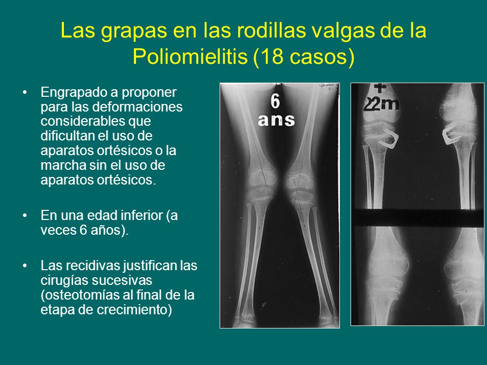 Las grapas en las rodillas valgas de la Poliomielitis (18 casos)