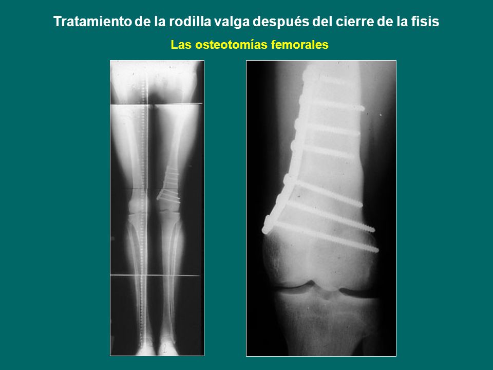Tratamiento de la rodilla valga después del cierre de la fisis