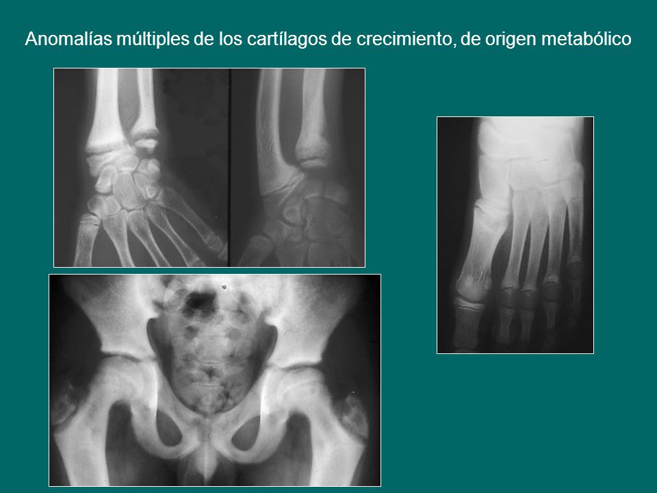 Anomalías múltiples de los cartílagos de crecimiento, de origen metabólico