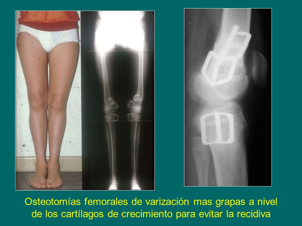 Osteotomías femorales de varización mas grapas a nivel de los cartílagos de crecimiento para evitar la recidiva