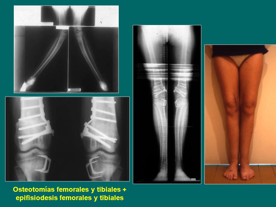 Osteotomías femorales y tibiales + epifisiodesis femorales y tibiales