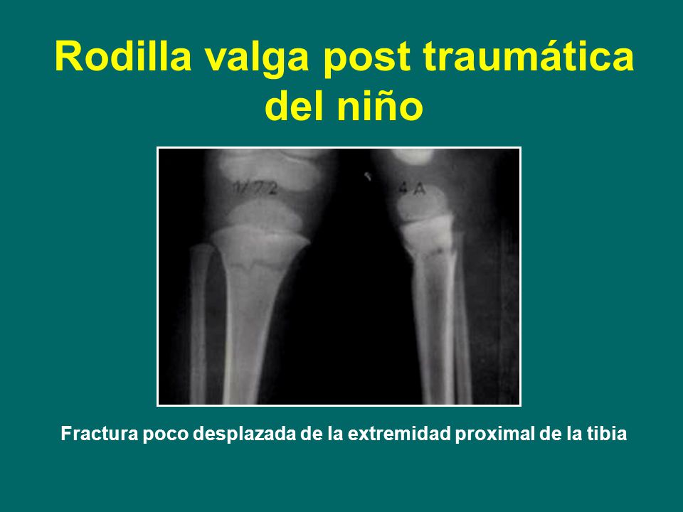 Fractura poco desplazada de la extremidad proximal de la tibia