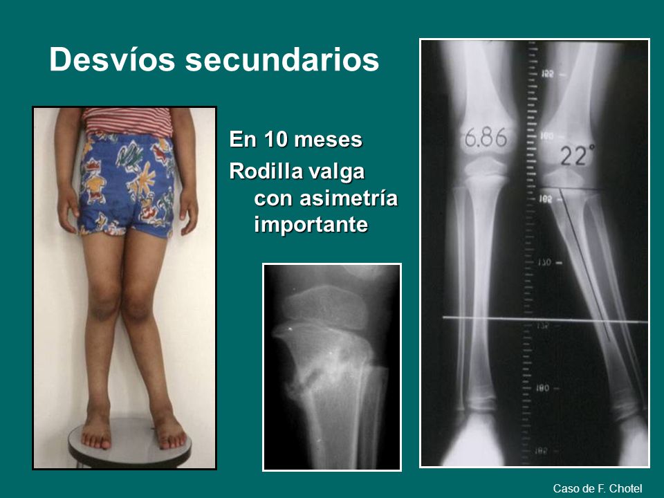 Desvíos secundarios En 10 meses Rodilla valga con asimetría importante