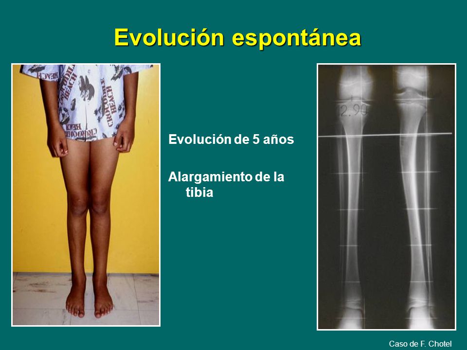 Evolución espontánea Evolución de 5 años Alargamiento de la tibia