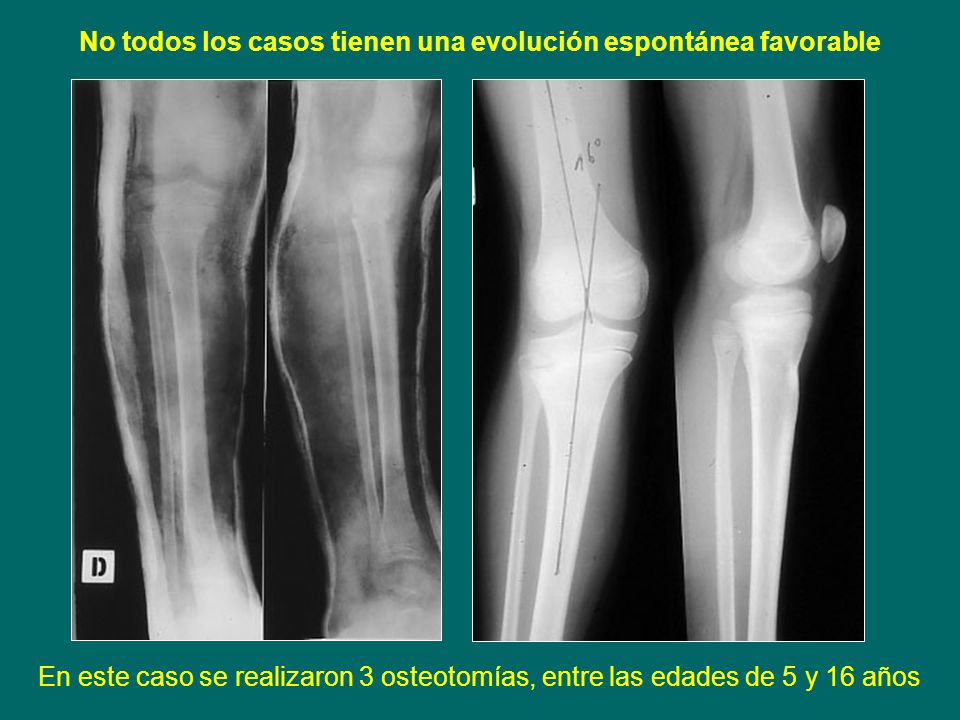 No todos los casos tienen una evolución espontánea favorable