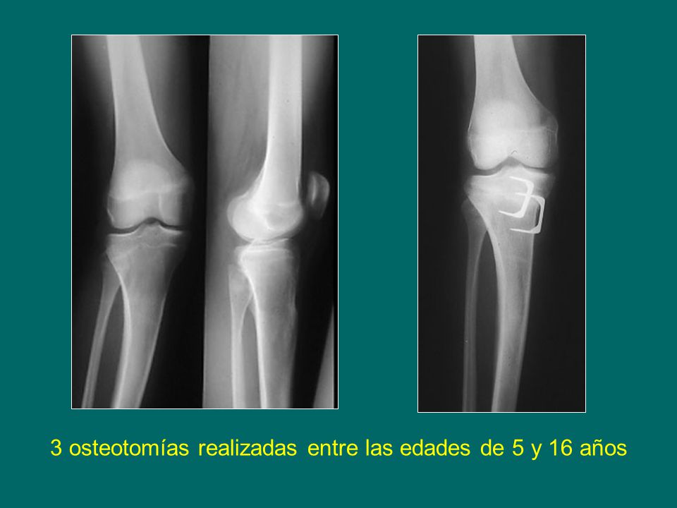 3 osteotomías realizadas entre las edades de 5 y 16 años