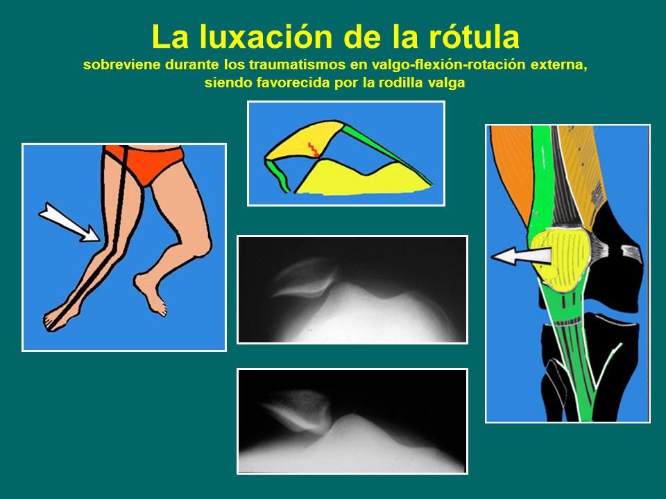 La luxación de la rótula sobreviene durante los traumatismos en valgo-flexión-rotación externa, siendo favorecida por la rodilla valga