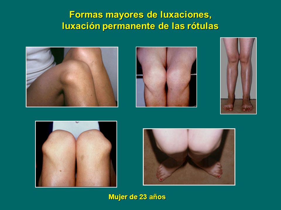 Formas mayores de luxaciones, luxación permanente de las rótulas