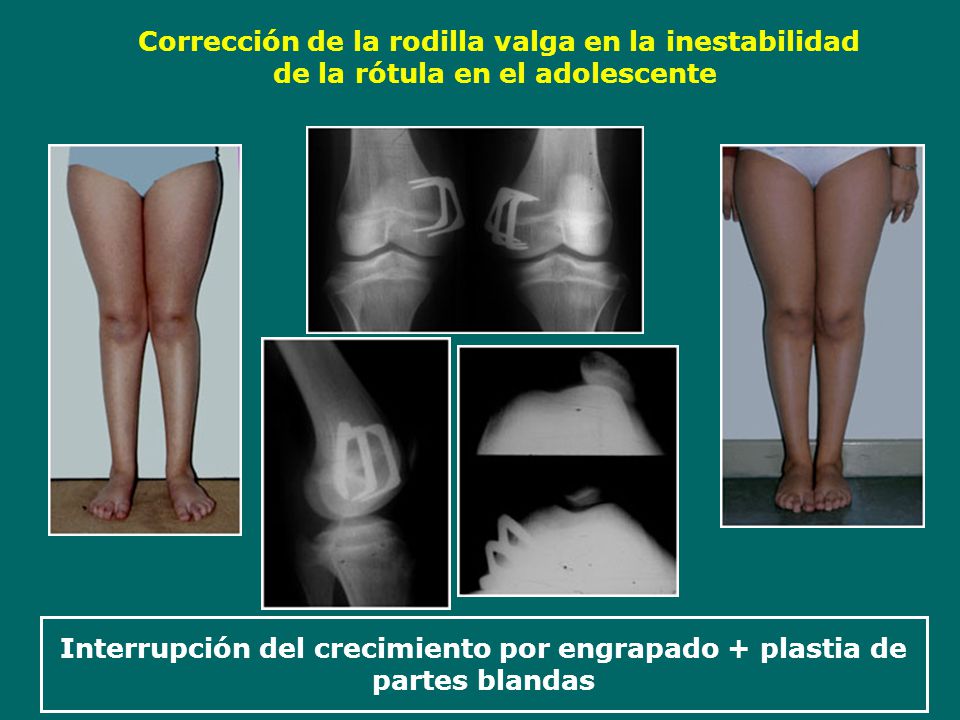 Interrupción del crecimiento por engrapado + plastia de partes blandas