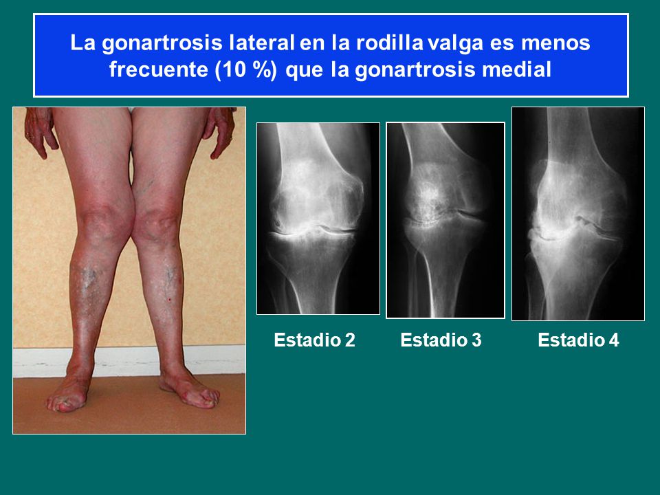 La gonartrosis lateral en la rodilla valga es menos frecuente (10 %) que la gonartrosis medial