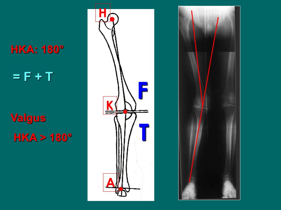 H HKA: 180° = F + T F K Valgus HKA > 180° T A
