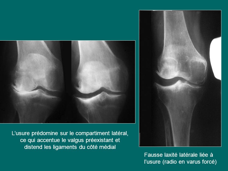 L’usure prédomine sur le compartiment latéral, ce qui accentue le valgus préexistant et distend les ligaments du côté médial