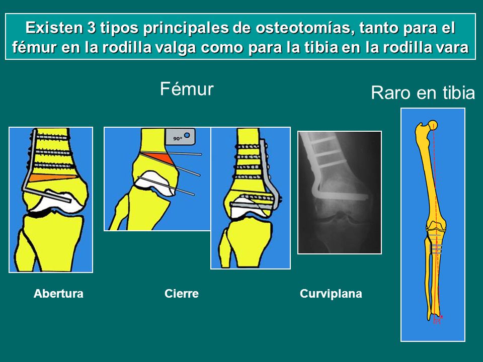 Existen 3 tipos principales de osteotomías, tanto para el fémur en la rodilla valga como para la tibia en la rodilla vara