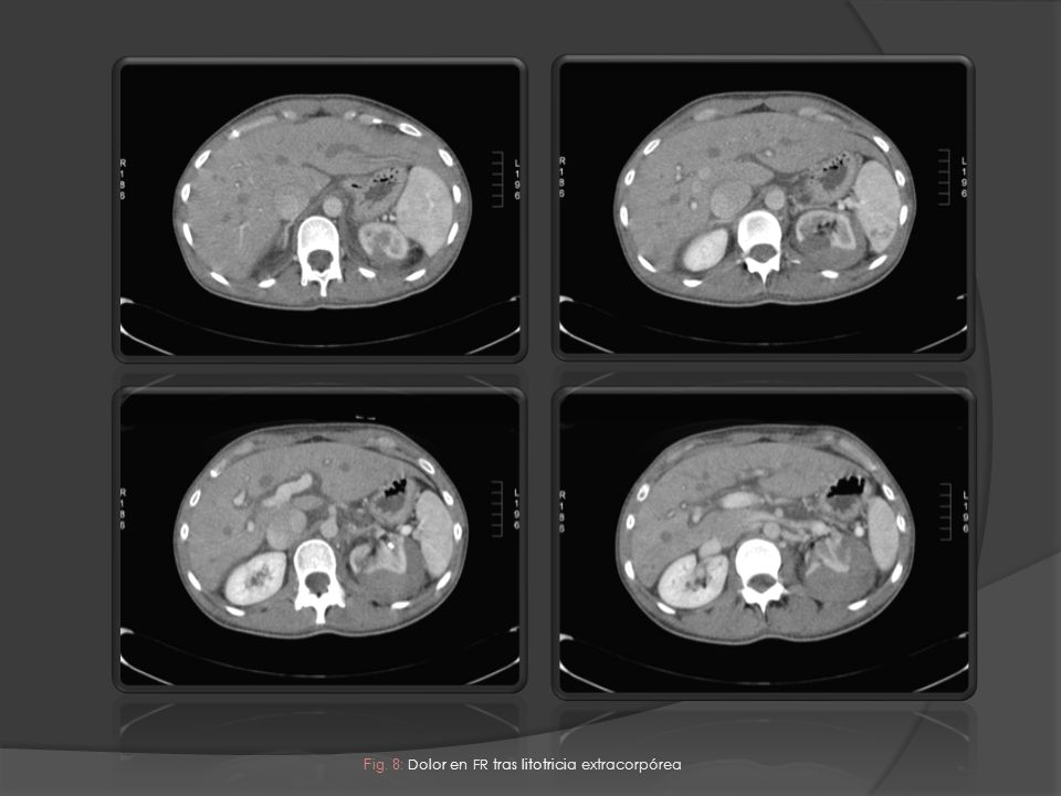 Fig. 8: Dolor en FR tras litotricia extracorpórea