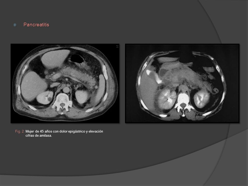 Pancreatitis Fig. 2: Mujer de 45 años con dolor epigástrico y elevación cifras de amilasa.