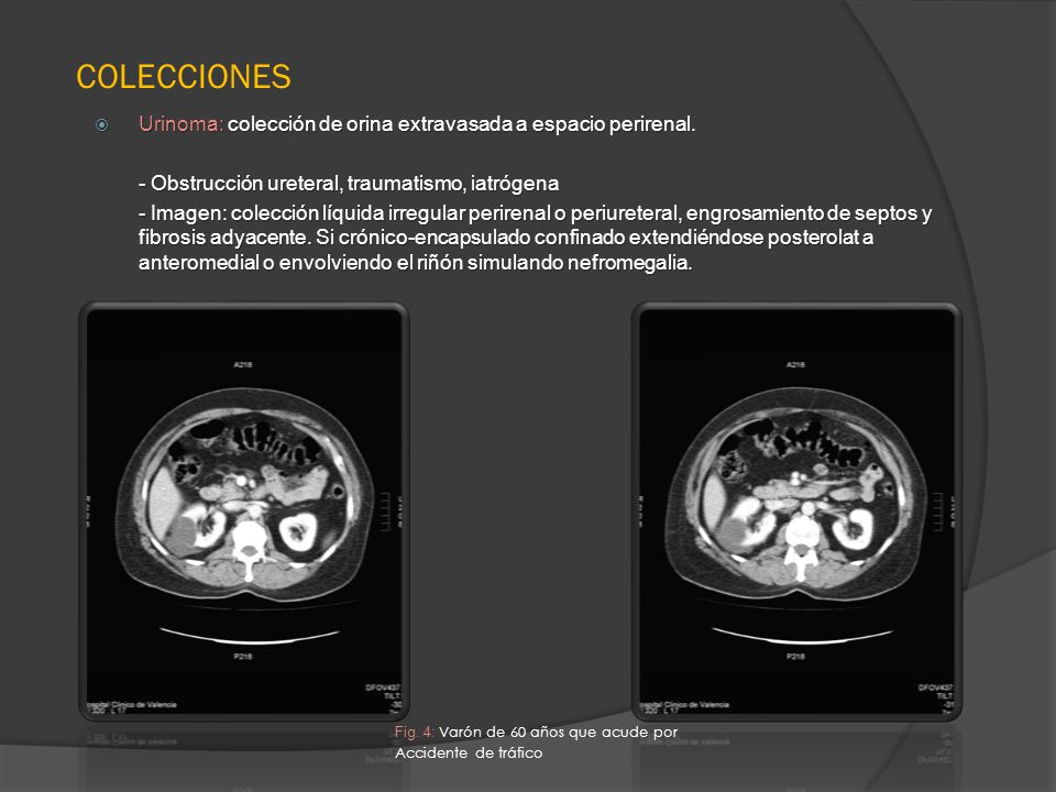 COLECCIONES Urinoma: colección de orina extravasada a espacio perirenal. - Obstrucción ureteral, traumatismo, iatrógena.
