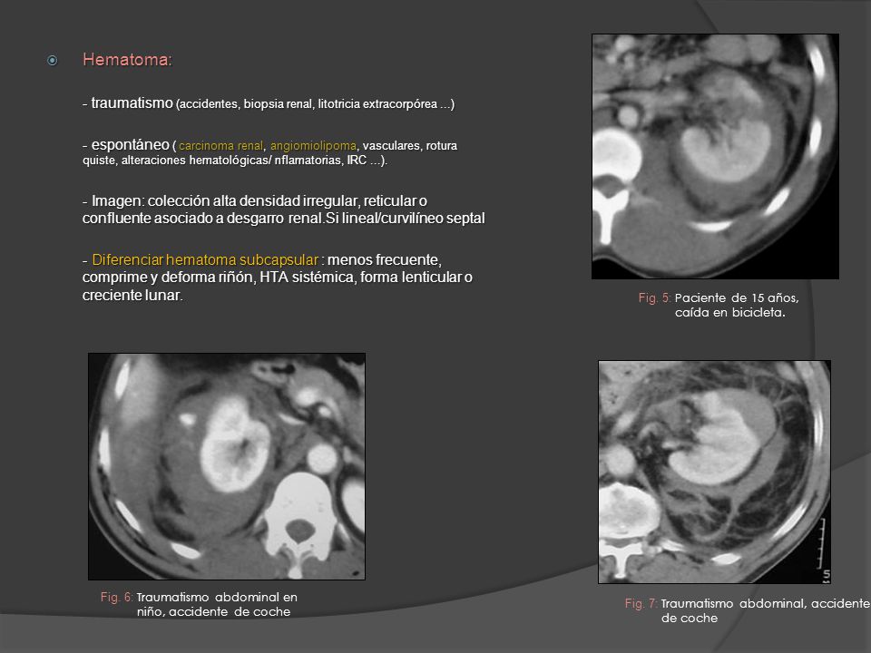 Hematoma: - traumatismo (accidentes, biopsia renal, litotricia extracorpórea ...)