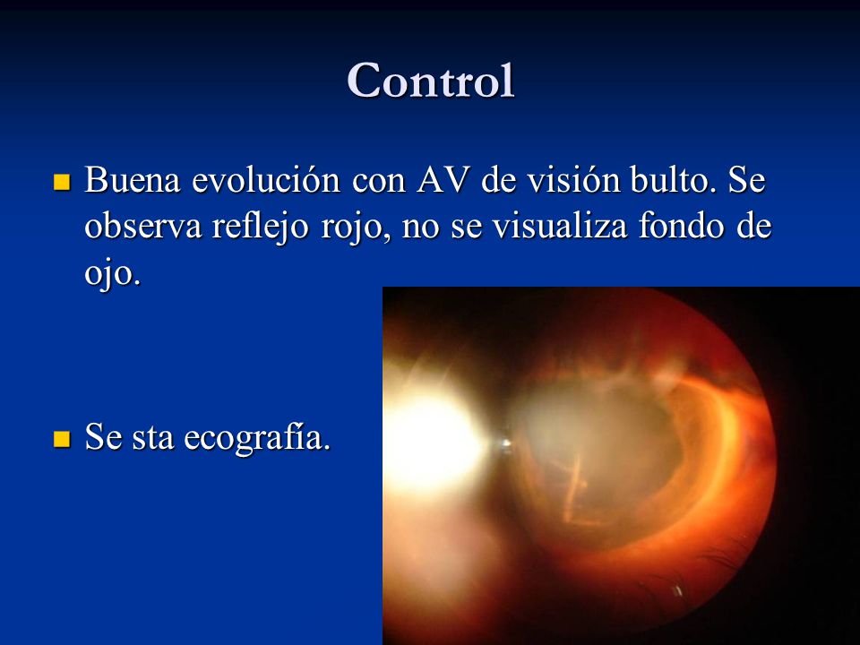 Control Buena evolución con AV de visión bulto. Se observa reflejo rojo, no se visualiza fondo de ojo.