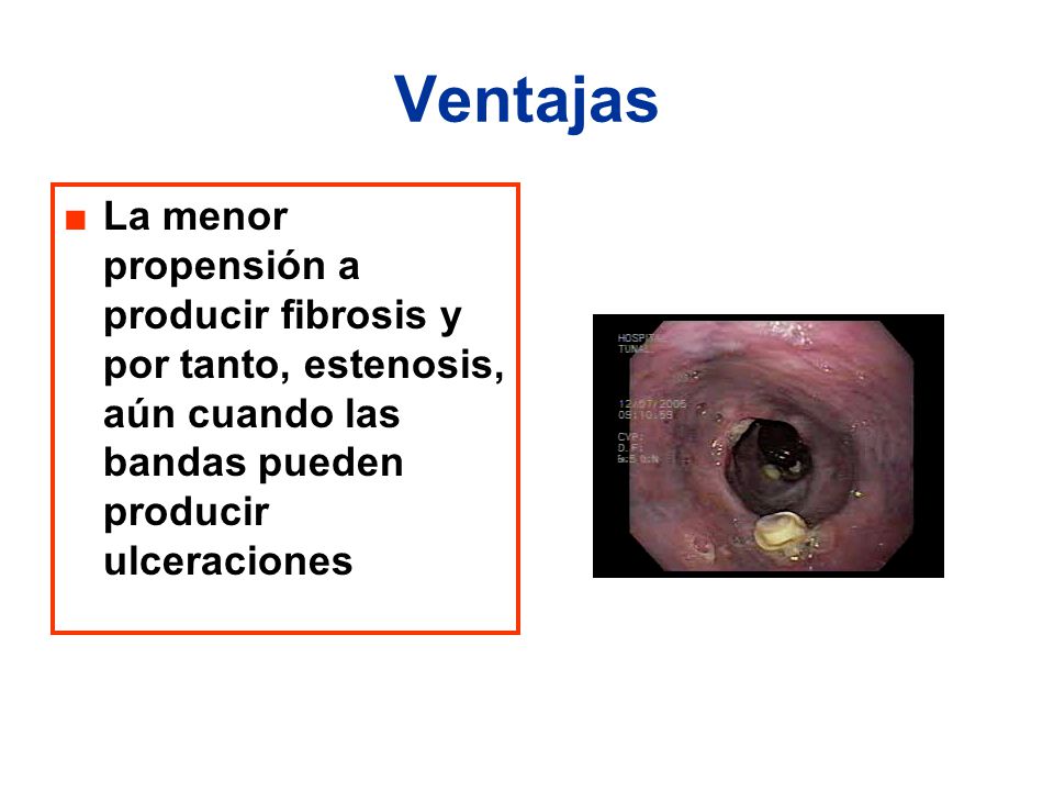 Ventajas La menor propensión a producir fibrosis y por tanto, estenosis, aún cuando las bandas pueden producir ulceraciones.