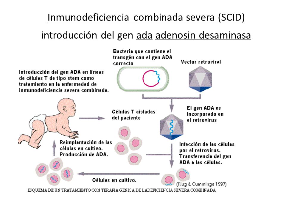 Inmunodeficiencia combinada severa (SCID) introducción del gen ada adenosin desaminasa