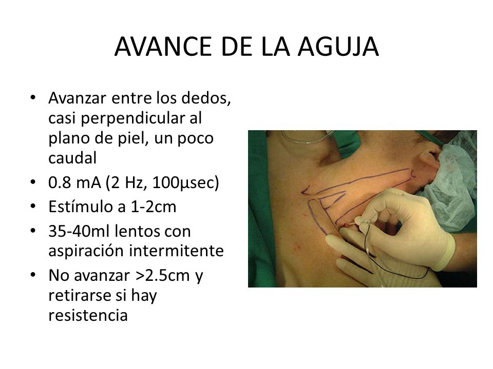 AVANCE DE LA AGUJA Avanzar entre los dedos, casi perpendicular al plano de piel, un poco caudal. 0.8 mA (2 Hz, 100µsec)