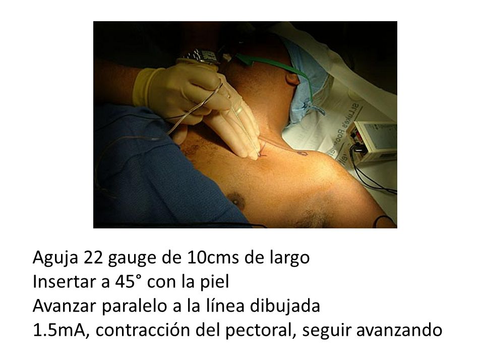 Aguja 22 gauge de 10cms de largo Insertar a 45° con la piel Avanzar paralelo a la línea dibujada 1.5mA, contracción del pectoral, seguir avanzando