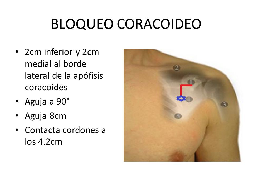 BLOQUEO CORACOIDEO 2cm inferior y 2cm medial al borde lateral de la apófisis coracoides. Aguja a 90°