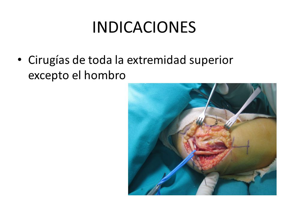 INDICACIONES Cirugías de toda la extremidad superior excepto el hombro