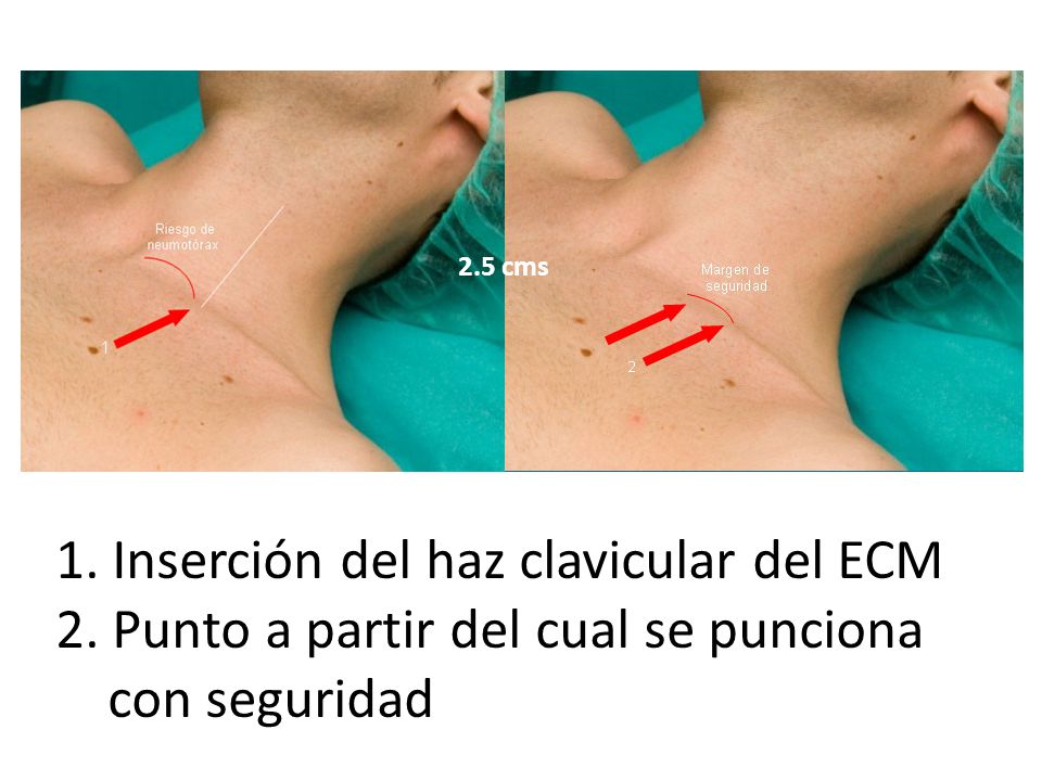 2.5 cms 1. Inserción del haz clavicular del ECM 2.