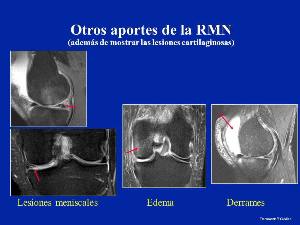 Otros aportes de la RMN (además de mostrar las lesiones cartilaginosas)