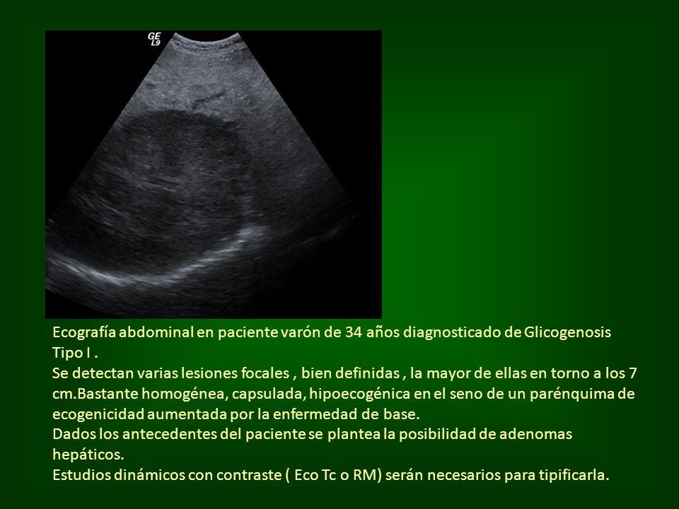 Ecografía abdominal en paciente varón de 34 años diagnosticado de Glicogenosis
