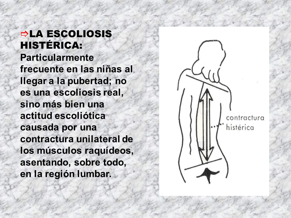 LA ESCOLIOSIS HISTÉRICA: Particularmente frecuente en las niñas al llegar a la pubertad; no es una escoliosis real, sino más bien una actitud escoliótica causada por una contractura unilateral de los músculos raquídeos, asentando, sobre todo, en la región lumbar.