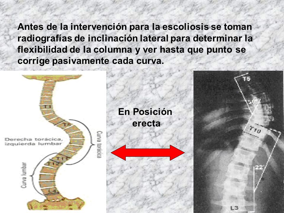 Antes de la intervención para la escoliosis se toman radiografías de inclinación lateral para determinar la flexibilidad de la columna y ver hasta que punto se corrige pasivamente cada curva.