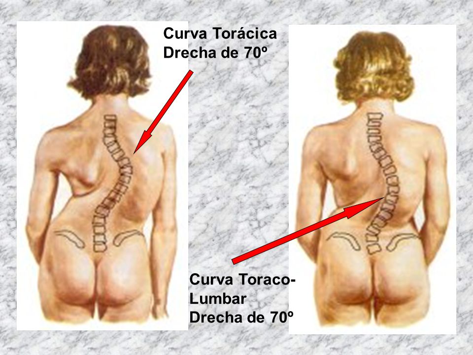 Curva Torácica Drecha de 70º Curva Toraco- Lumbar Drecha de 70º
