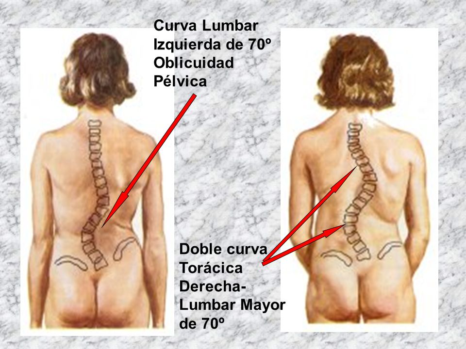 Curva Lumbar Izquierda de 70º Oblicuidad Pélvica Doble curva Torácica Derecha-Lumbar Mayor de 70º