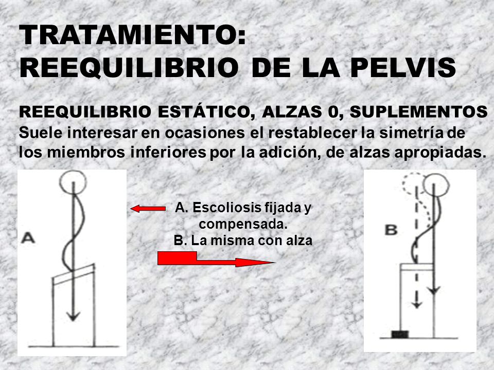 A. Escoliosis fijada y compensada. B. La misma con alza
