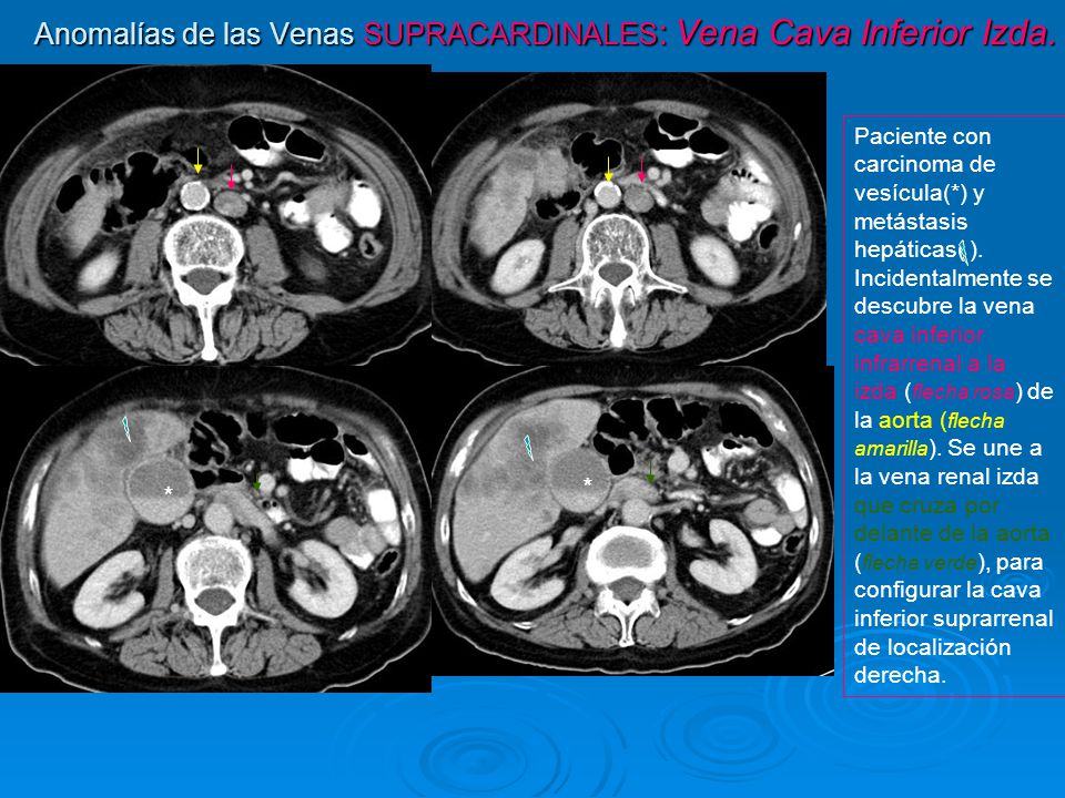 Anomalías de las Venas SUPRACARDINALES: Vena Cava Inferior Izda.