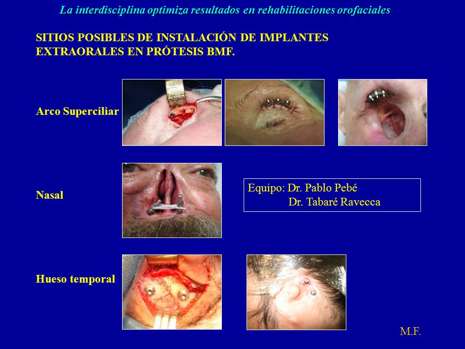 SITIOS POSIBLES DE INSTALACIÓN DE IMPLANTES EXTRAORALES EN PRÓTESIS BMF.