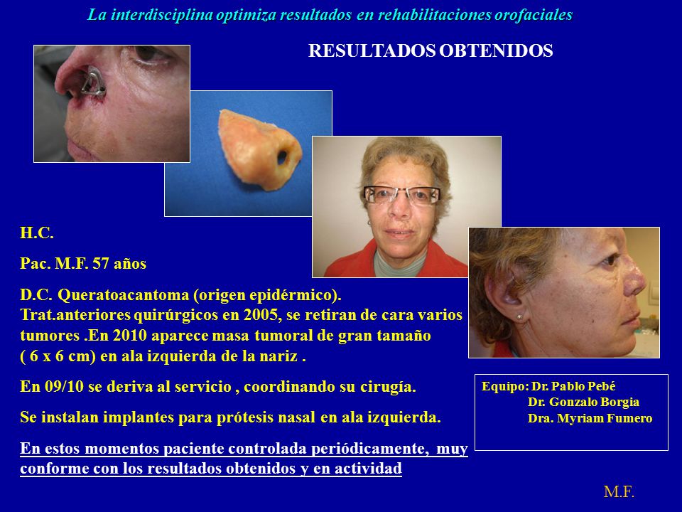 RESULTADOS OBTENIDOS M.F. H.C. Pac. M.F. 57 años. D.C. Queratoacantoma (origen epidérmico).