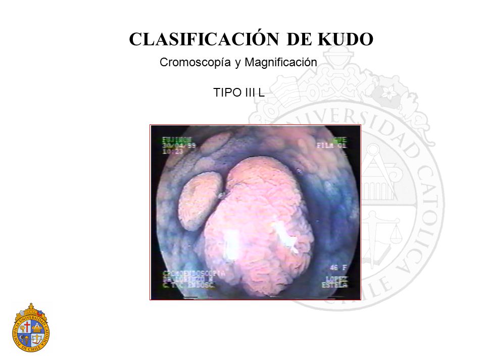 CLASIFICACIÓN DE KUDO Cromoscopía y Magnificación TIPO III L 14