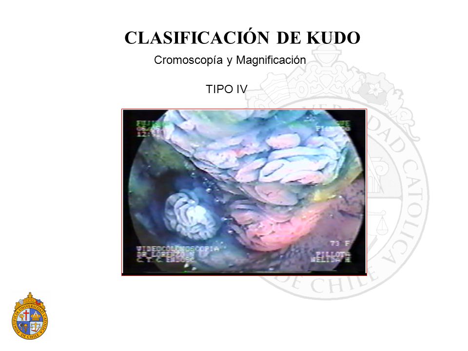 CLASIFICACIÓN DE KUDO Cromoscopía y Magnificación TIPO IV 16