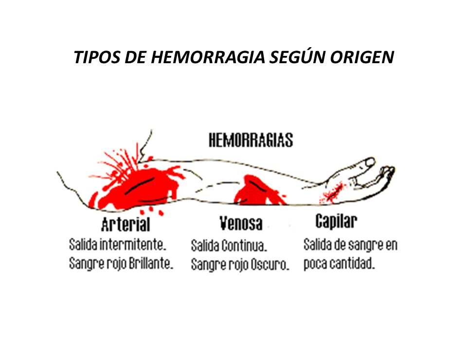 TIPOS DE HEMORRAGIA SEGÚN ORIGEN