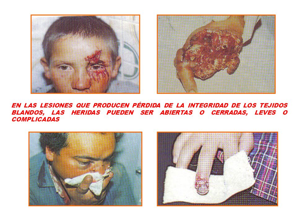 EN LAS LESIONES QUE PRODUCEN PÉRDIDA DE LA INTEGRIDAD DE LOS TEJIDOS BLANDOS, LAS HERIDAS PUEDEN SER ABIERTAS O CERRADAS, LEVES O COMPLICADAS
