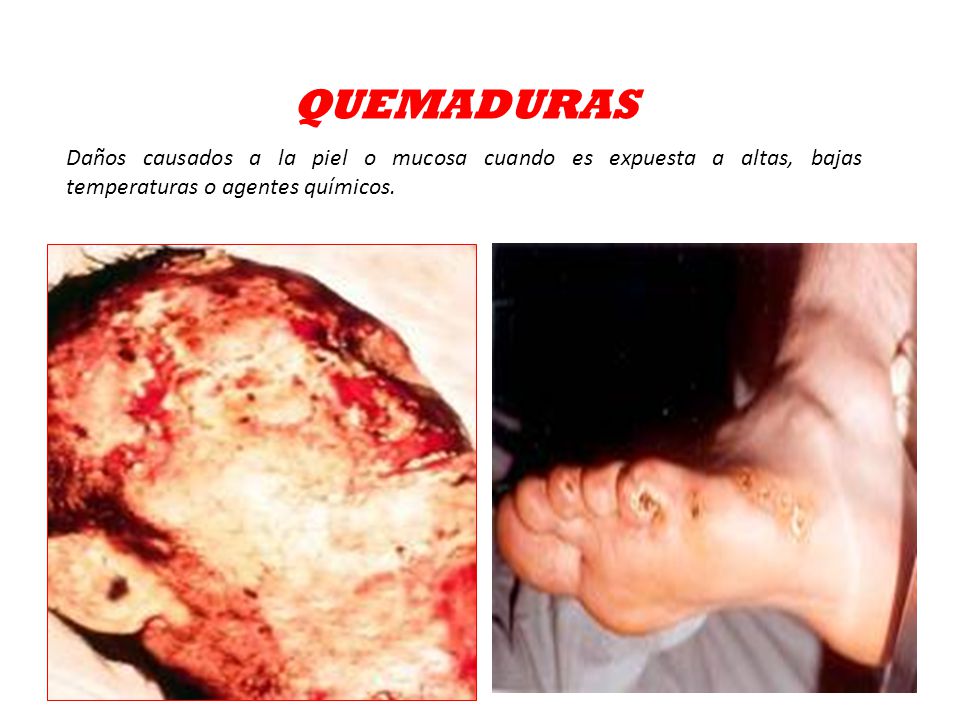 QUEMADURAS Daños causados a la piel o mucosa cuando es expuesta a altas, bajas temperaturas o agentes químicos.