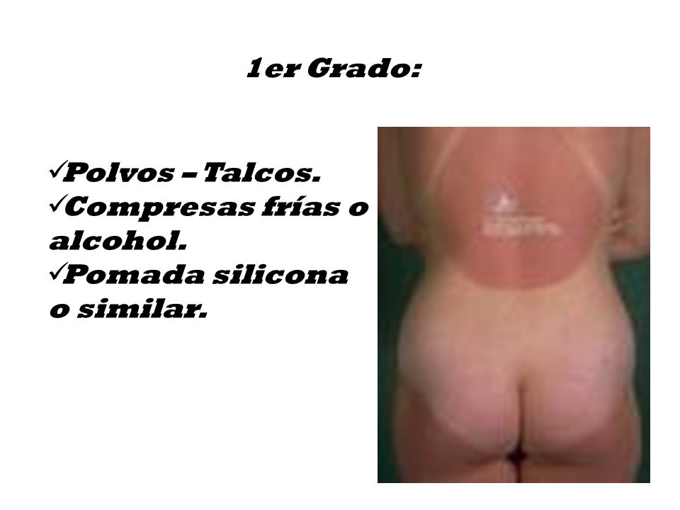 1er Grado: Polvos – Talcos. Compresas frías o alcohol. Pomada silicona o similar.