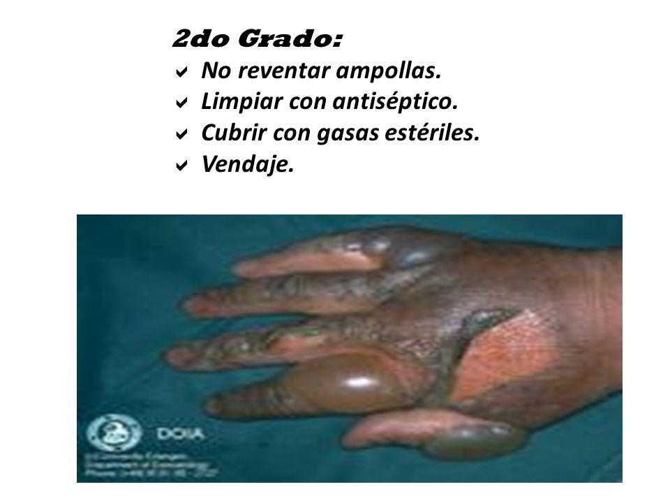 2do Grado: No reventar ampollas. Limpiar con antiséptico. Cubrir con gasas estériles. Vendaje.